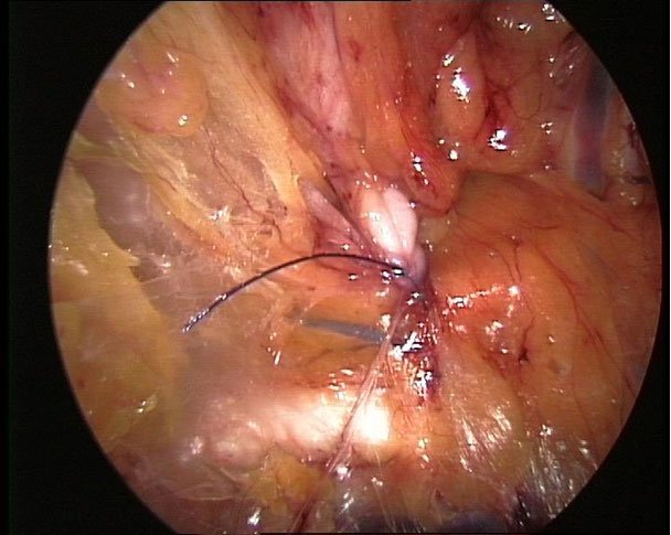 Minimalinvasive Hernienchirurgie in Schlüsselloch-Technik – feine Naht- und Netzversorgung der Bruchpforte.